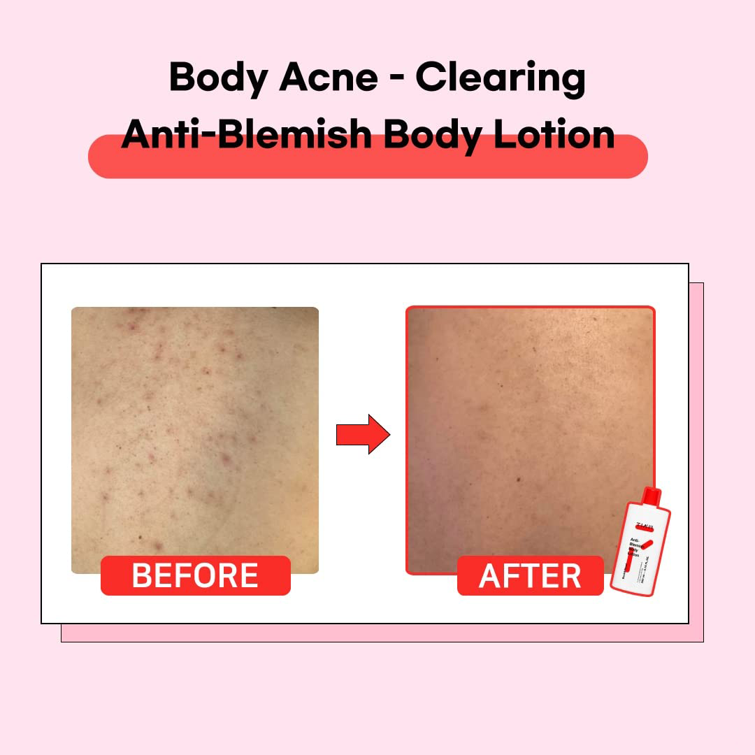 [Tiam] *renewal* Anti-Blemish Body Lotion 200ml